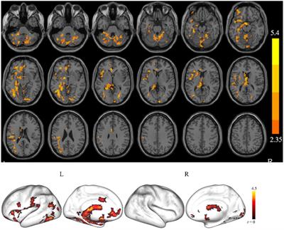 Altered brain spontaneous activity in patients with cerebral small vessel disease using the amplitude of low-frequency fluctuation of different frequency bands